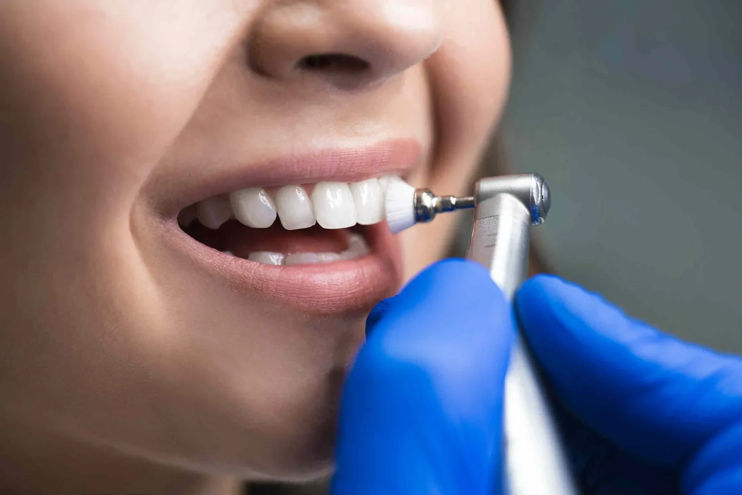 Translucent E-max lithium disilicate dental crowns