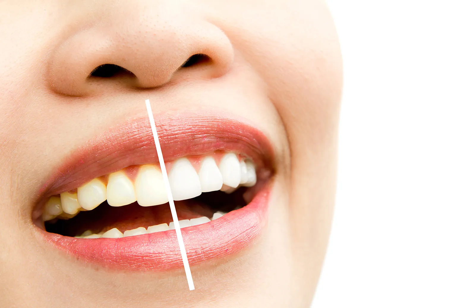 Shade guide used for professional teeth whitening comparison